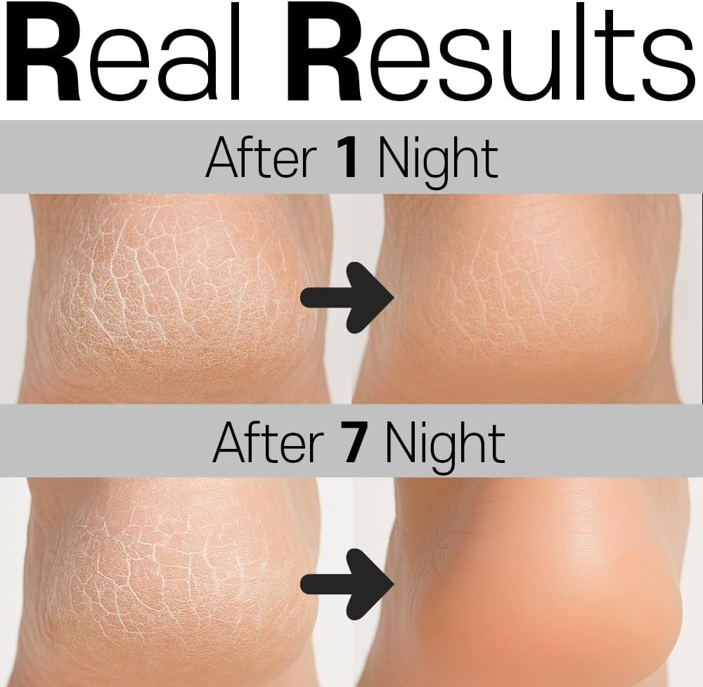 Moisturizing Heel Socks for Cracked Heels 2 Pairs (4 Socks) – Sillicon Gel Heel Socks for Dry Feet, Overnight Foot Care