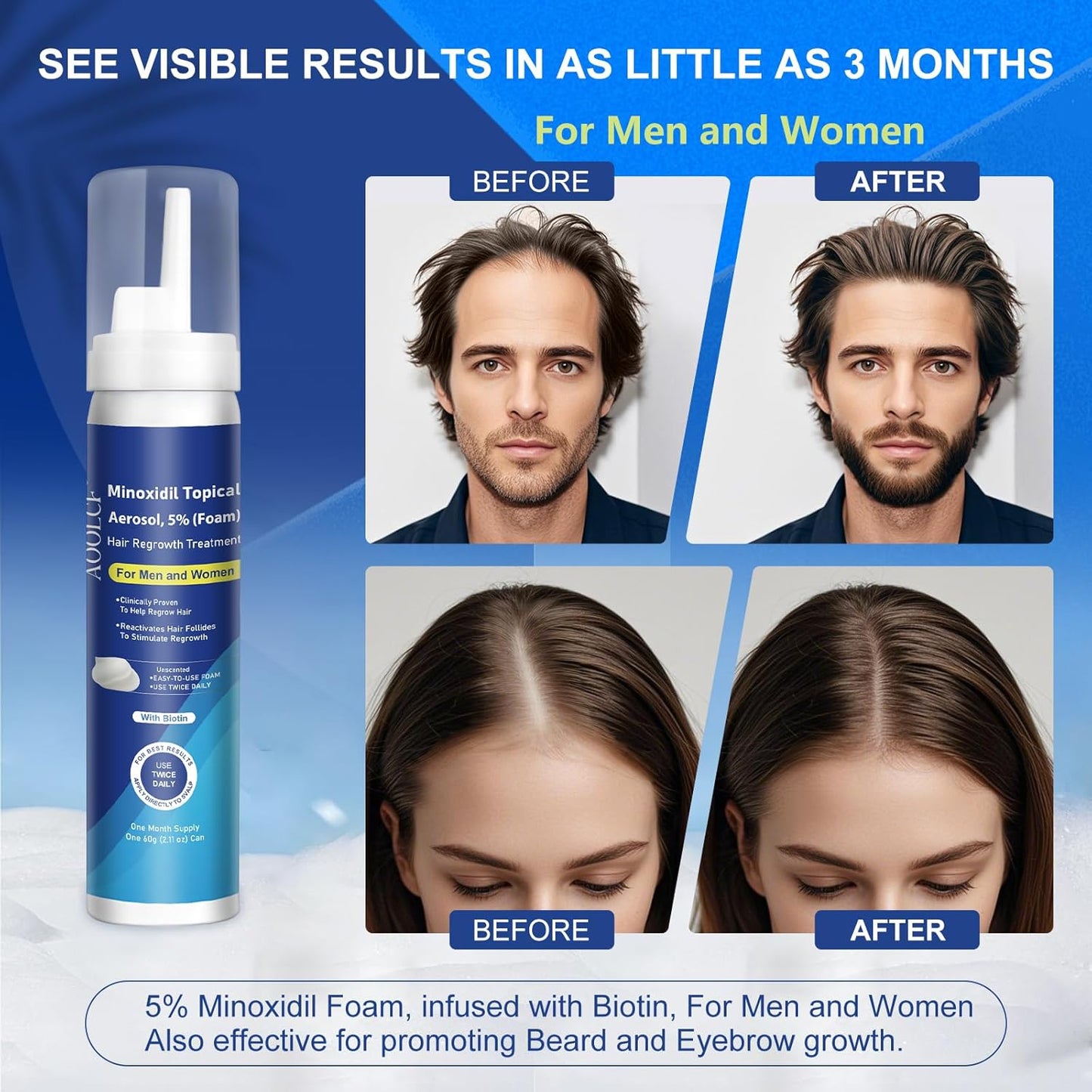 5% Topical Minoxidil Foam, Minoxidil for Men and Women, Infused with Biotin, Hair Growth Treatment, Supports Thicker and Fuller Hair & Beard (Minoxidil Foam, 12.66oz, 6 Month Supply)