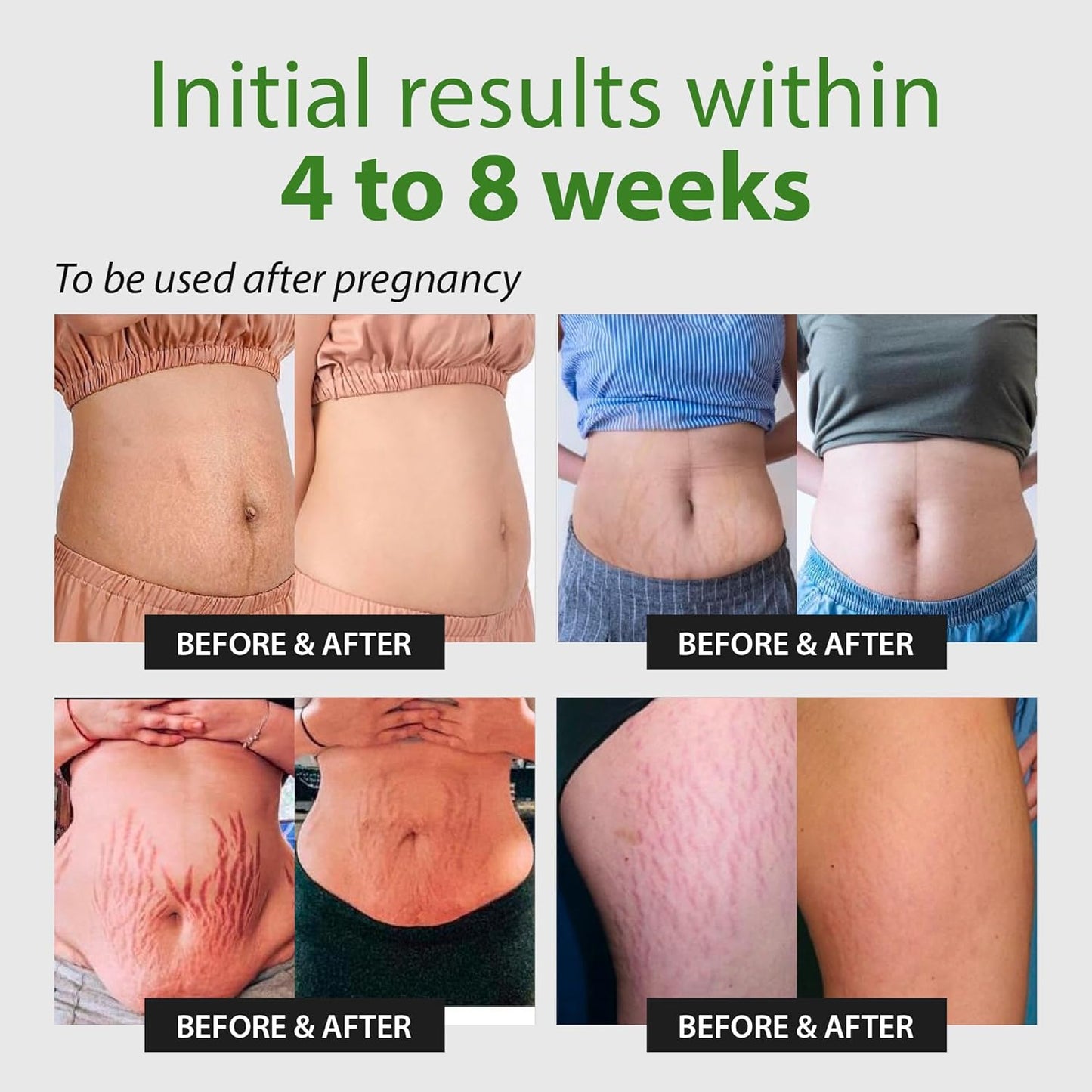 Abera Ovela Maternity Stretch Mark Cream for Pregnancy and Weight Fluctuations, Stretch Mark Treatment Pregnancy Must Haves, Deep Stretch Mark Removal, All Skin Types, 1.69 fl oz, Set of 3